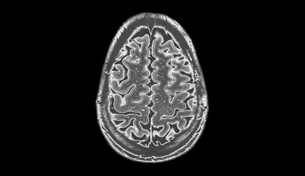 Cerebral Venous Thrombosis Desktop