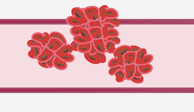 Venous Thrombosis Desktop